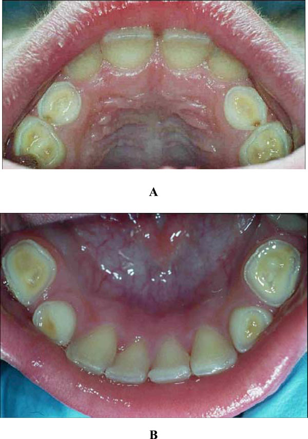 Soft Drink, Software and Softening of Teeth â€“ a Case Report of Tooth Wear in the Mixed Dentition Due to a Combination of Dental Erosion and Attrition
