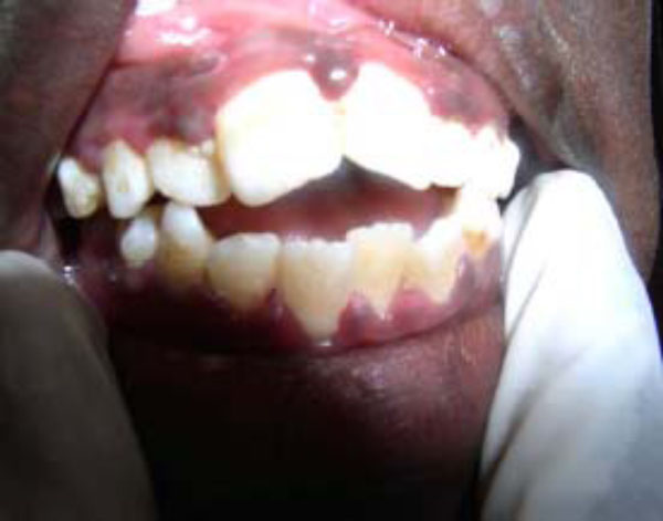 NOMA: A Preventable “Scourge” of African Children