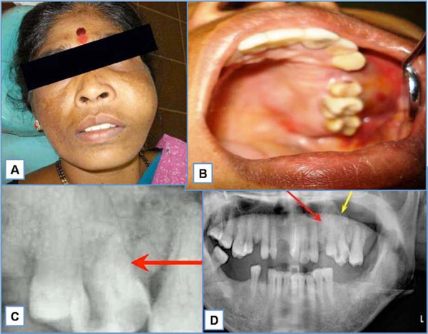 Fibroblastic Variant of Osteosarcoma: A Challenge in Diagnosis & Management