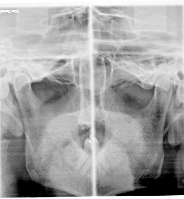 A Case Report of the Symptom-Relieving Action of an Anterior Flat Plane Bite Plate for Temporomandibular Disorder