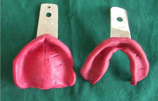 Corrective Primary Impression Technique