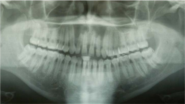 Rare Bilateral Nasopalatine Duct Cysts: A Case Report