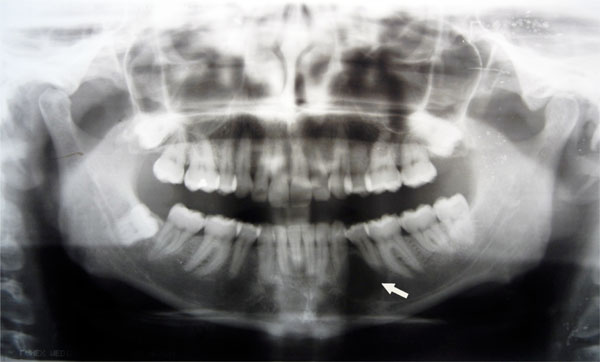 Glandular Odontogenic Cyst: Review of Literature and Report of a New Case with Cytokeratin-19 Expression