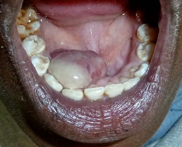 A Gray-purple Mass on the Floor of the Mouth: Gigantic Mucogingival Pyogenic Granuloma in a Teenage Patient