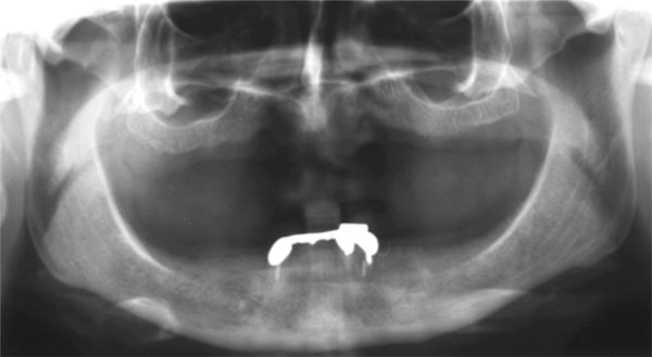 Alveolar Ridge Augmentation with Titanium Mesh. A Retrospective Clinical Study