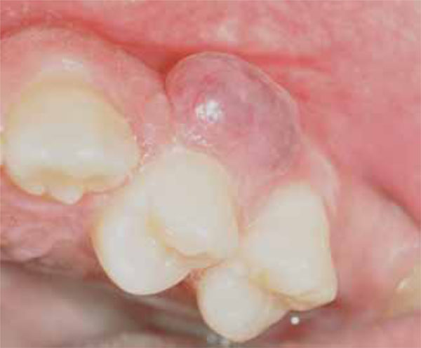 Peripheral Desmoplastic Ameloblastoma in Adolescent Age: Clinico-Pathological and Immunohistochemical Analisys of a Case