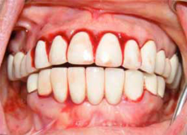 Immune Thrombocytopenic Purpura Presenting as Unprovoked Gingival Hemorrhage: a Case Report