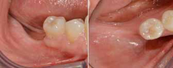  Vertical Guided Bone Regeneration using Titanium-reinforced d-PTFE Membrane and Prehydrated Corticocancellous Bone Graft 