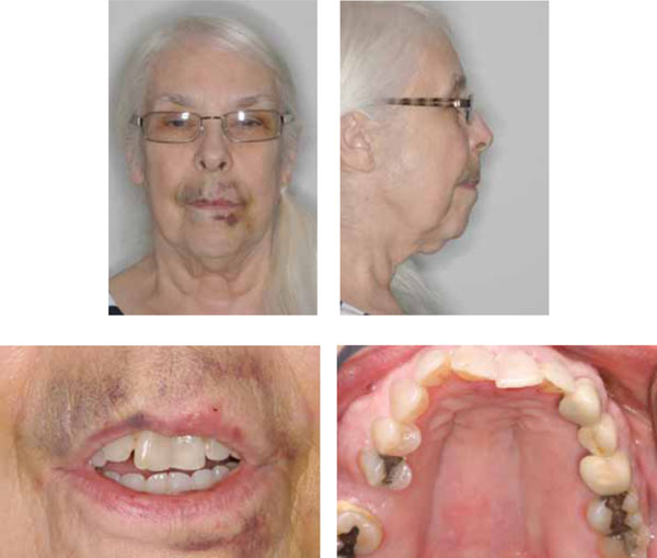  Interdisciplinary Trauma Management in an Elderly Patient, A Case Report