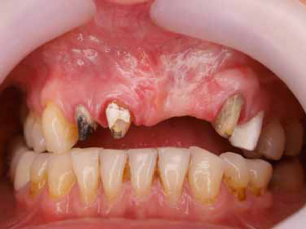 Combined Soft and Hard Tissue Peri-Implant Plastic Surgery Techniques to Enhance Implant Rehabilitation: A Case Report