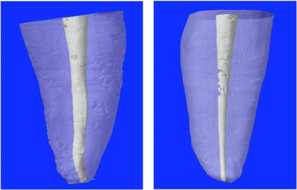 Temperature Profiles Along the Root with Gutta-percha Warmed through Different Heat Sources