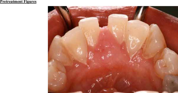 Central Odontogenic Fibroma of the Gingiva: A Case Report
