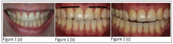 Congenitally Missing Maxillary Lateral Incisors: Update on the Functional and Esthetic Parameters of Patients Treated with Implants or Space Closure and Teeth Recontouring