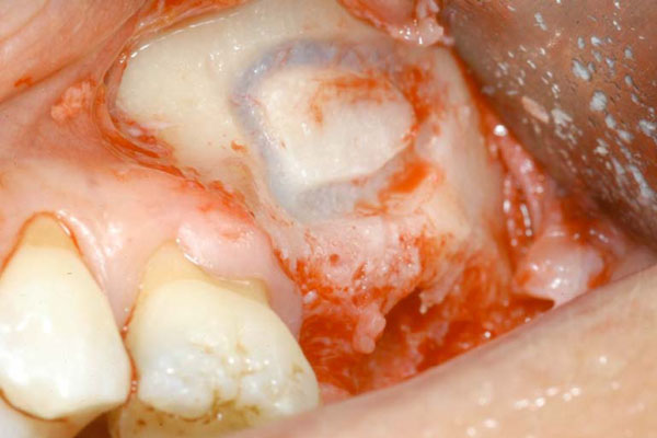  Alveolar Antral Artery Isolation During Sinus Lift Procedure with the Double Window Technique