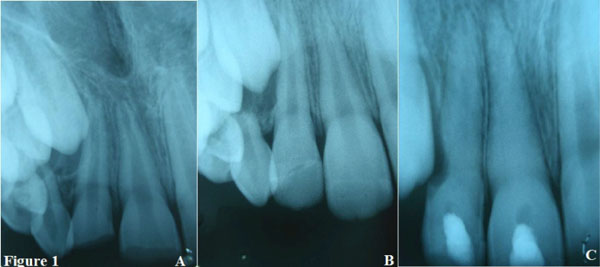 Root Resorption a 6-Year Follow-up Case Report