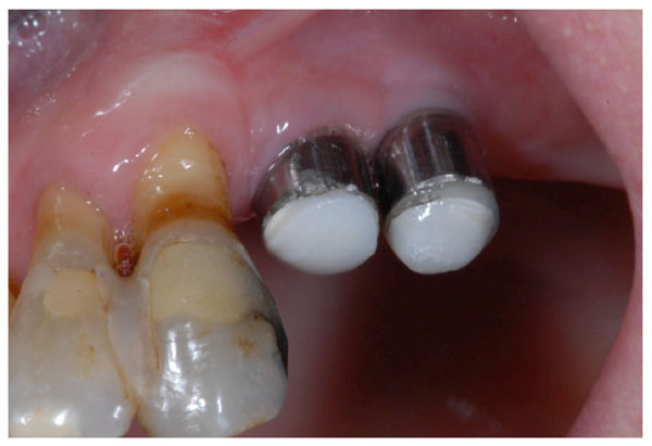 Effect of Fluoride and Chlorhexidine Digluconate Mouthrinses on Plaque Biofilms 