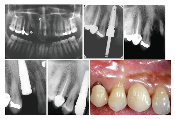  Unconventional Implant Placement IV. Implant Placement through Impacted Teeth to Avoid Invasive Surgery. Long-term Results of 3 Cases
