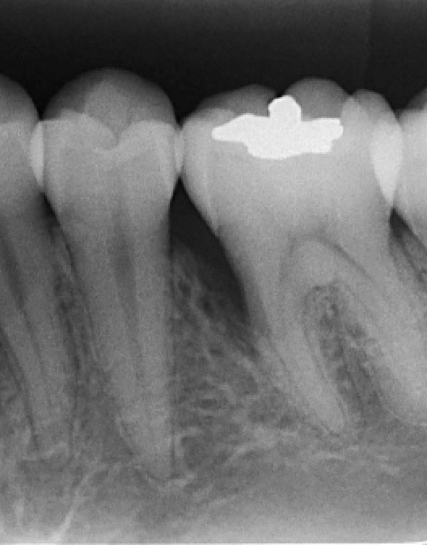  Squamous Odontogenic Tumor: Literature Review Focusing on the Radiographic Features and Differential Diagnosis