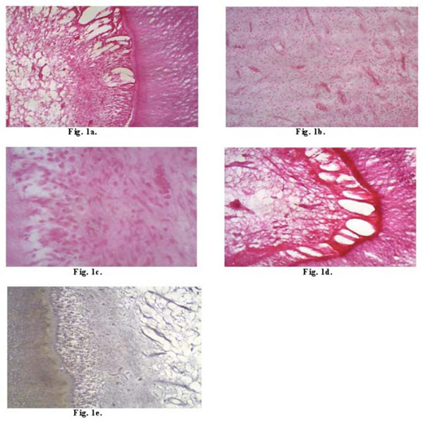  Evaluation of Biocompatibility of an Etch-and-Rinse Adhesive System Based in Tertiary Butanol Applied in Deep Cavity