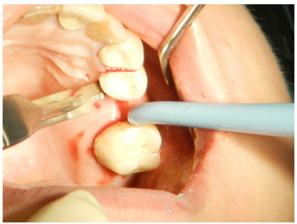 The Effect of Flapless and Full-thickness Flap Techniques on Implant Stability During the Healing Period 