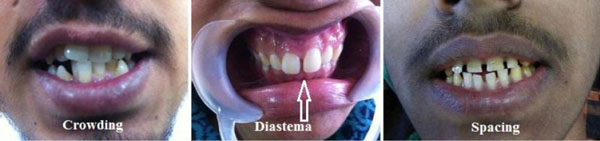 Dental Evidence in Forensic Identification – An Overview, Methodology and Present Status