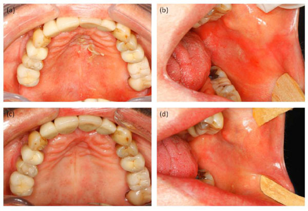  Cinnamon-induced Oral Mucosal Contact Reaction