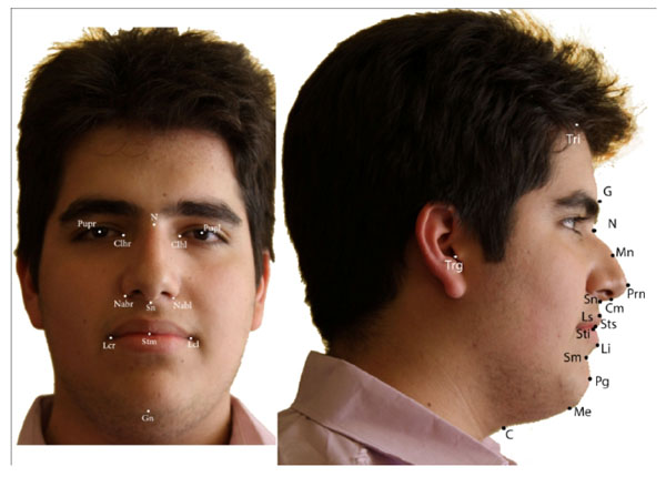  Photographic Facial Soft Tissue Analysis by Means of Linear and Angular Measurements in an Adolescent Persian Population