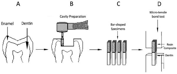 Evaluating Resin-Dentin Bond by Microtensile Bond Strength Test: Effects of Various Resin Composites and Placement Techniques