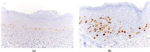 Predictive Role of p53 Protein as a Single Marker or Associated with ki67 Antigen in Oral Leukoplakia: A Retrospective Longitudinal Study