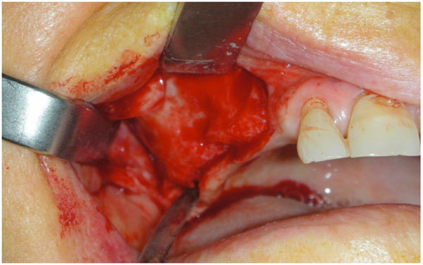 Sinus Lift Augmentation by Using Calcium Sulphate. A Retrospective 12 Months Radiographic Evaluation Over 25 Treated Italian Patients
