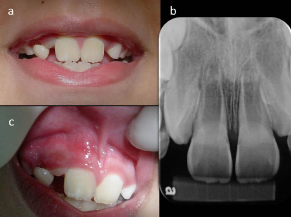 Revascularization of an Immature Tooth with Apical Periodontitis Using
Calcium Hydroxide: A 3-year Follow-up