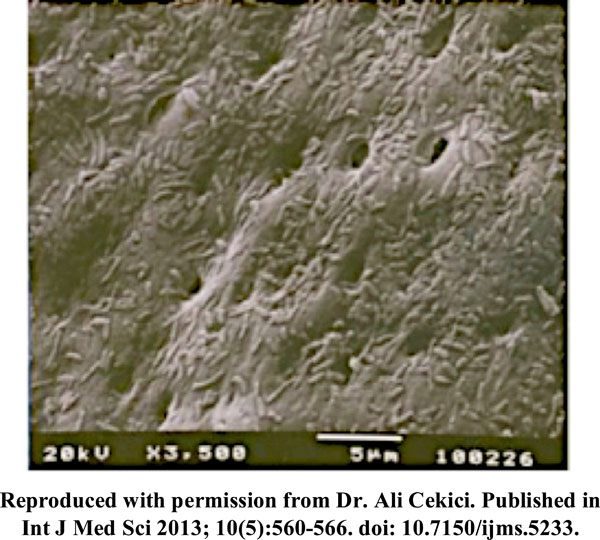 Root Surface Bio-modification with Erbium Lasers- A Myth or a Reality??